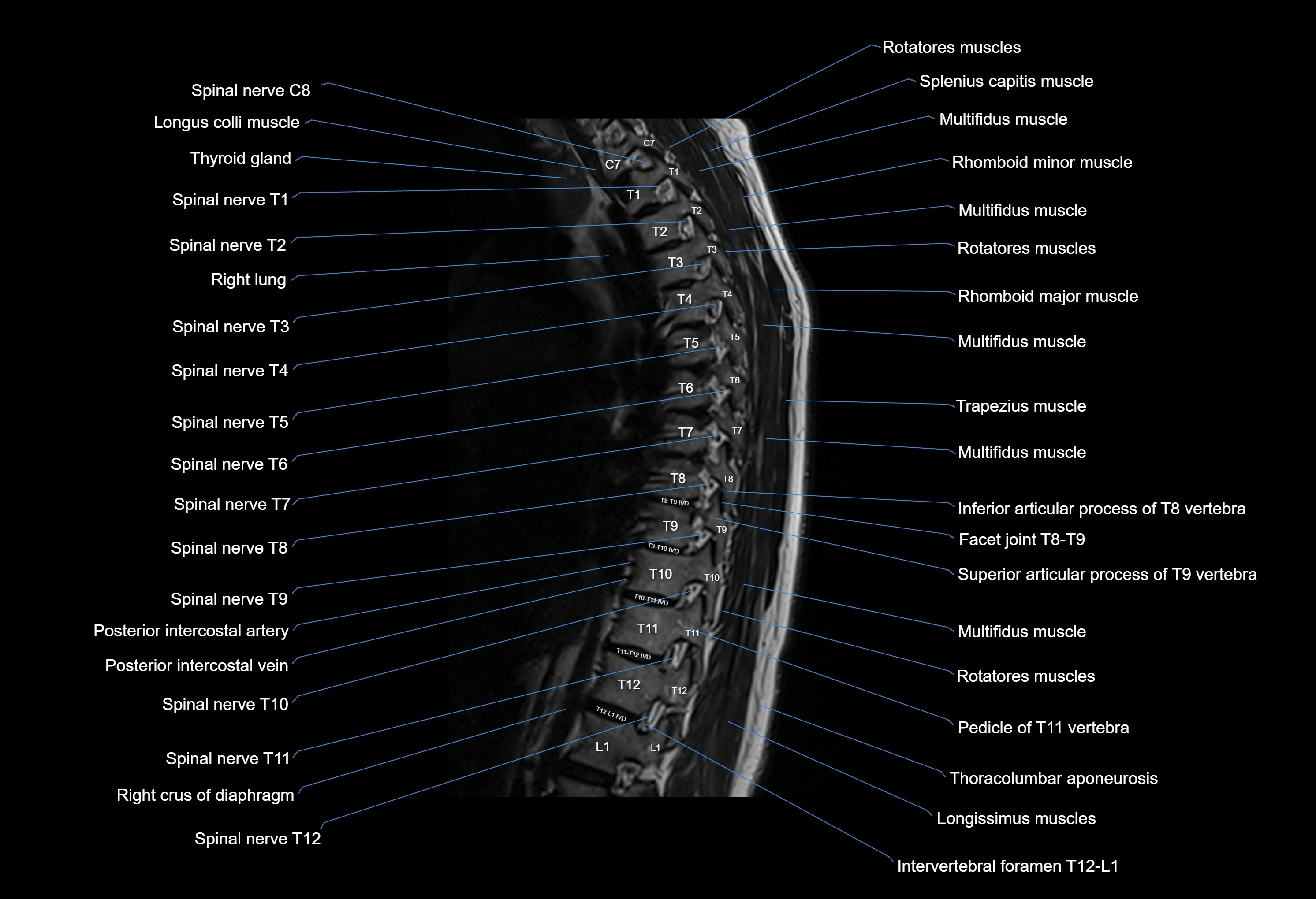 MRI thoracic spine sagittal  cross sectional anatomy 3T radiology  image-img-00001-00007.webp